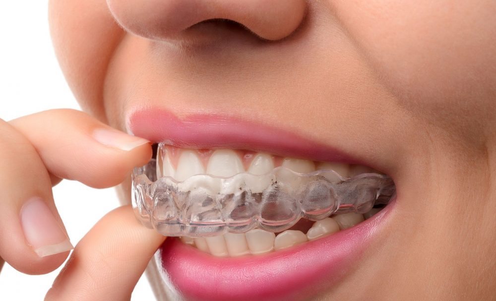 Invisalign vs. Aparelhos Convencionais: Qual é o Melhor para Você?